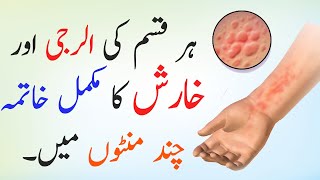 Kharish our Allergy Ka Ilaj | Alergy ka khatma