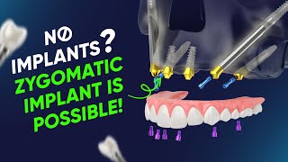Zygomatic Implants Explained | Fixed Teeth for Severe Bone Loss