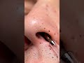 “Most Satisfying Blackhead Vacuum Extraction Ever! Real Deep Pore Cleaning ASMR for Stress Relief,