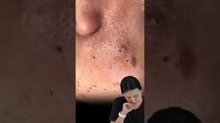 이거이거 너무 작은가 Monster Blackheads removal video clip 블랙헤드제거