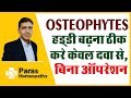 OSTEOPHYTES |HINDI |BONE SPUR | हड्डी बढ़ना ठीक करे केवल दवा से,बिना ऑपरेशन |हड्डी बढ़ने का कारण |इलाज