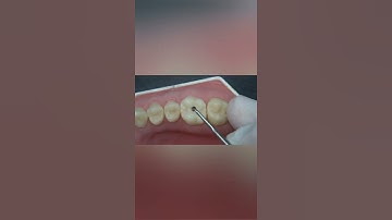 Composite restoration teeth upper 6.Shorts. Link to the full video in the comments.