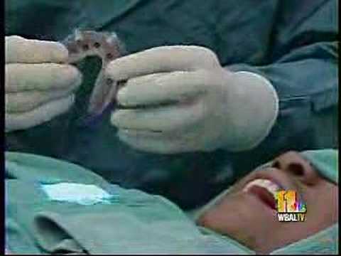 Dr. Bernard Krupp, Teeth-In-An-Hour Surgery!