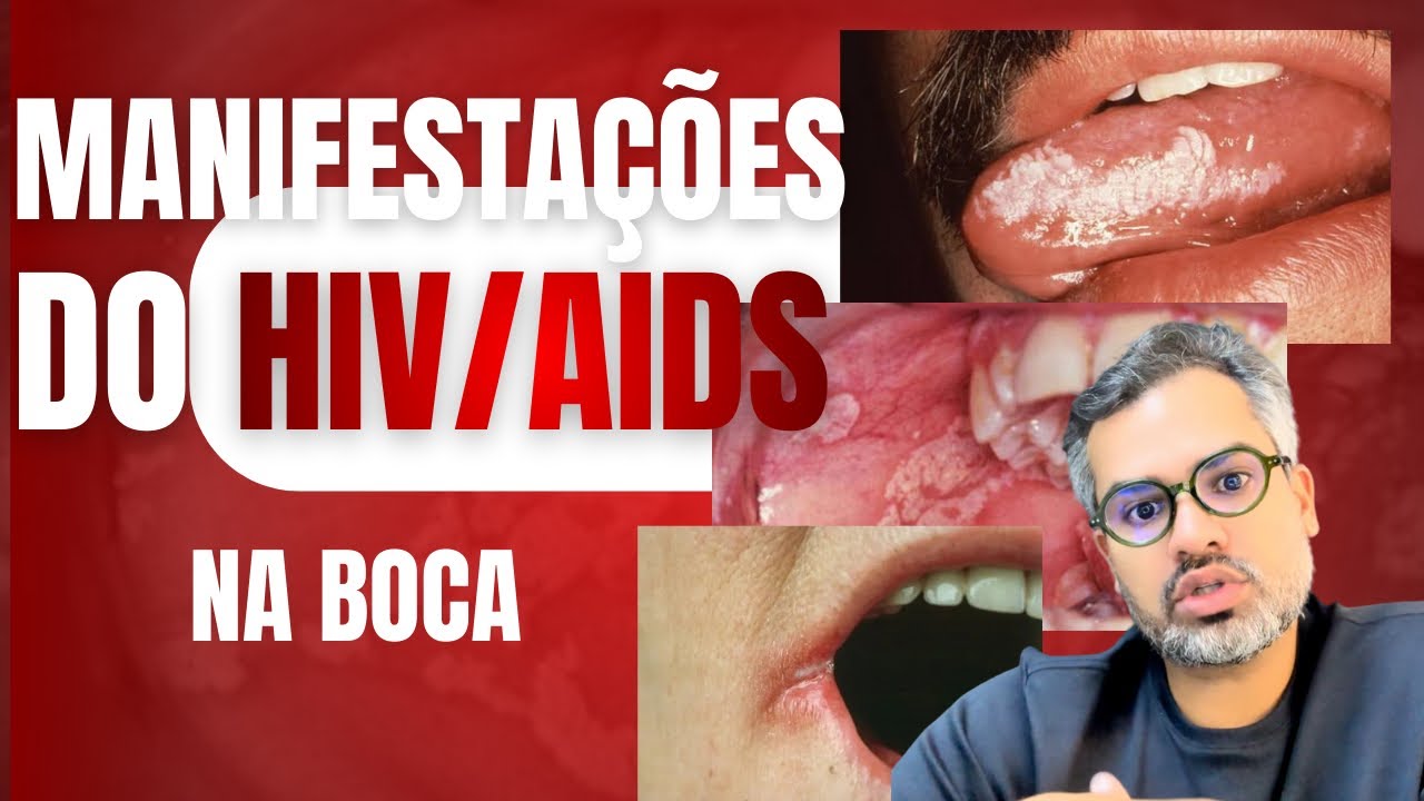 Manifestações na boca do HIV/AIDS! #drfranciscodeassisjr - YouTube