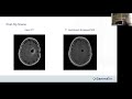GammaTile Webinar: Neurosurgeon's AANS Abstract Presentation