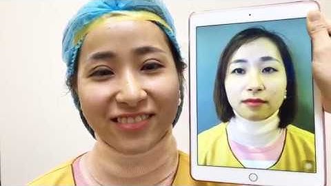 Kết Quả Cắt Mí Mani Mini Deep 5D Tại VTM Dr.Hải Lê.