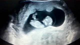 Letícia Brincando De Escorregar