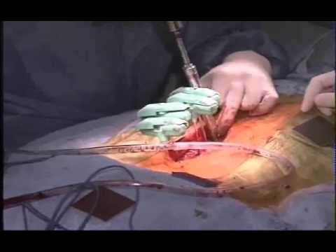 Cirugía Mini-Invasiva de Hernia Discal con Endoscopio