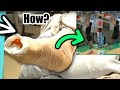 How Jayson Tatum Is Already Walking Without A Boot After an Achilles Tear