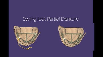 Exocad Swing lock Partial Denture