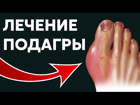 Как лечить подагру в домашних условиях быстро и эффективно