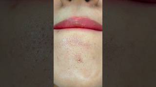 How remove Chin Whitehead & blackhead at home remedy shorts youtubeshorts trendinghacks short