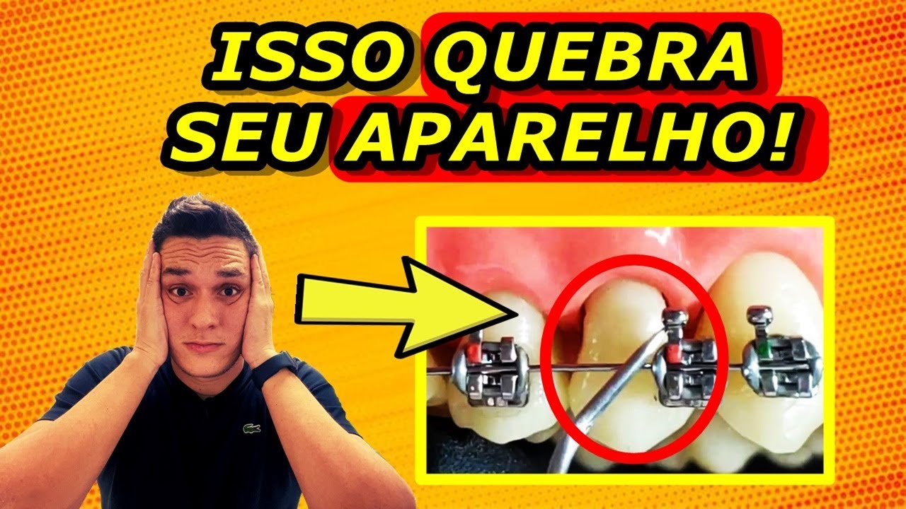 OS 3 ALIMENTOS QUE MAIS QUEBRAM O APARELHO ORTODÔNTICO FIXO! | O QUE PODE E O QUE NÃO PODE COMER?
