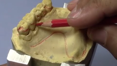 Designing & Blockout Case 2 - Free End Saddle, Angulation of Teeth