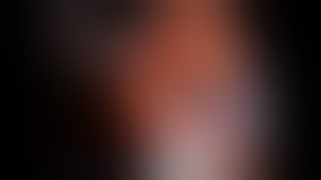 Difficult  Robotic Pyeloplasty due to Pre-Op Stent Placement