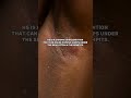 Painful Armpit Bump? It Might Not Be What You Think…