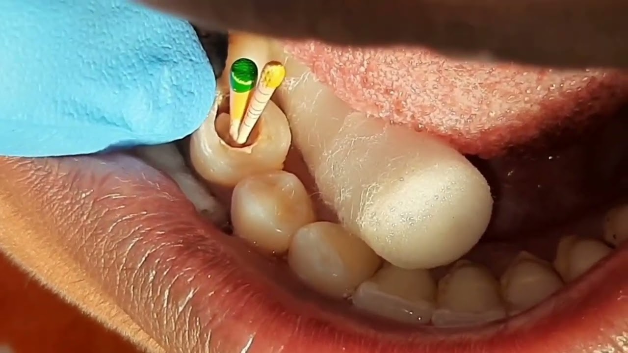 Root canal obturation with Lateral Condensation & tooth Restore by