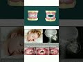 Effects of thumb sucking habit  child dentist  patient education animation