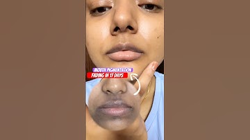 Mouth Pigmentation Removal in 17 days✅