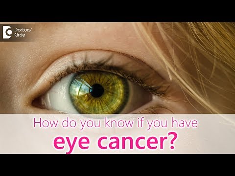 Video: Eye Cancer - Causes, Signs, Symptoms And Treatment Of Eye Cancer
