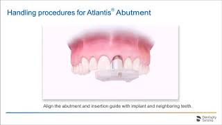 Atlantis Insertion Guide (with subtitle)