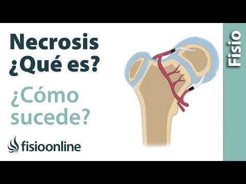 Vídeo: Necrosis Avascular (osteonecrosis): Tratamiento, Causas Y Más