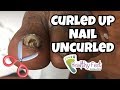 Curled Up Ingrown Nail Uncurled. Ingrown Nail Removal.