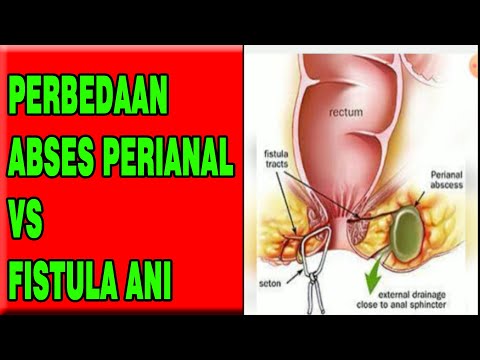 Video: Perbedaan Antara Celah Dan Fistula