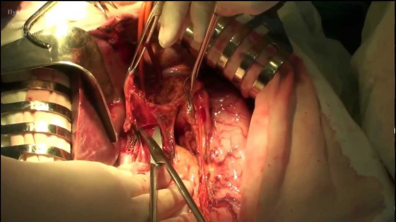 D2 Gastrectomy  for locally advanced gastric cancer