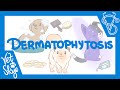 Dermatophytosis