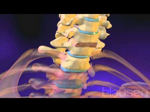 Vídeo: Fusión De Columna Vertebral Y Colectivo