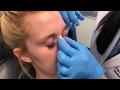 Non-Surgical Nose Job by Dr. Tareen