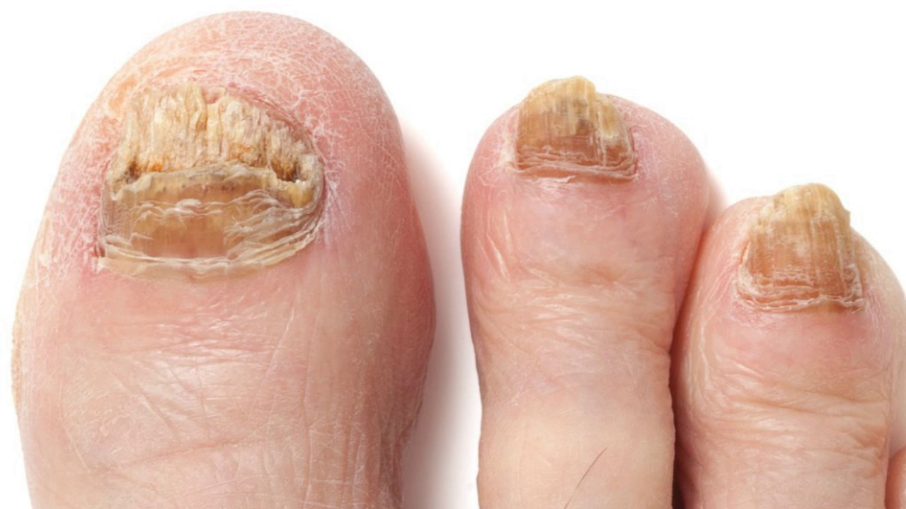 Top 5 home remedies for toenail fungus - TheHealthSite.com