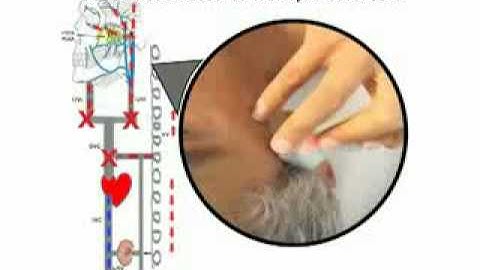 CCSVI and Multiple Sclerosis  ENGLISH AUDIO  1