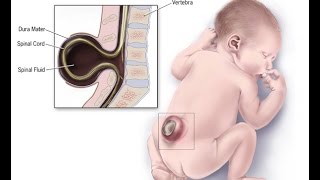 Neural Tube Defects