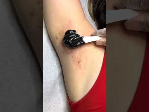 Under Arms Waxing Bodywax Brazillianwax Hairremoval Viralvideo 
