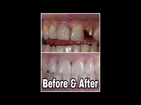 Fațetele Dentare - TOTUL (Cum se lipesc, CÂT rezistă) / Dentistry Hub