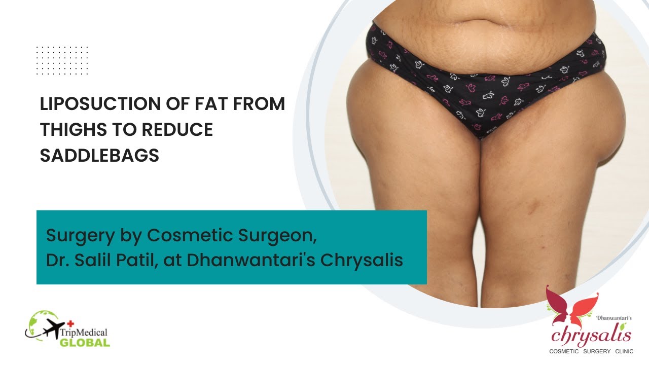Liposuction of fat from thigh saddlebags for better body contour YouTube
