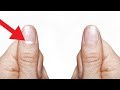 नाखून पर सफेद निशान | Nail White Marks Explained