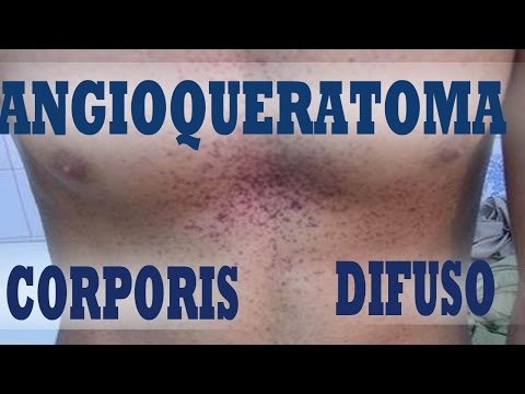 Angioqueratoma escroto imágenes del