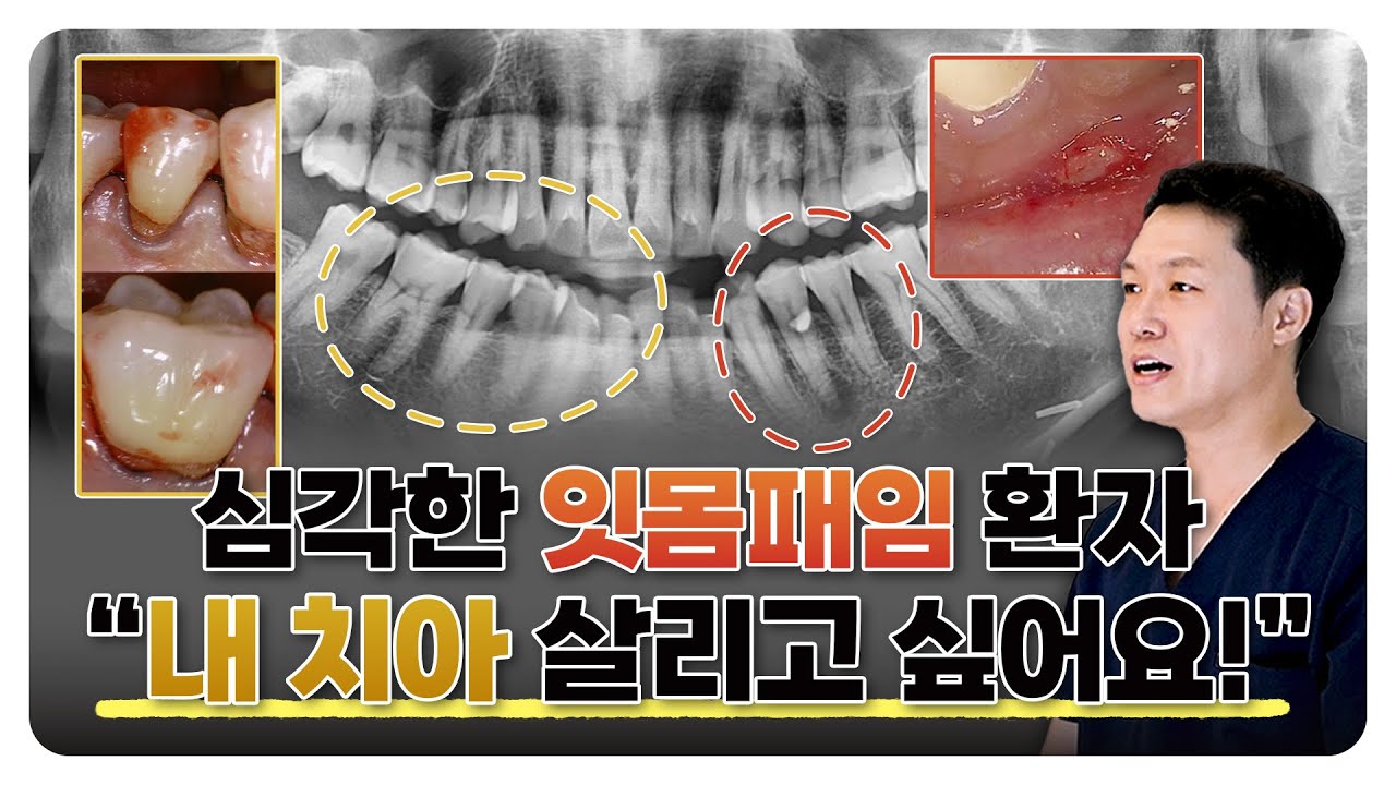 심각한 잇몸패임으로 발치 진단 받았는데..치아 살리기 가능할까요? - YouTube