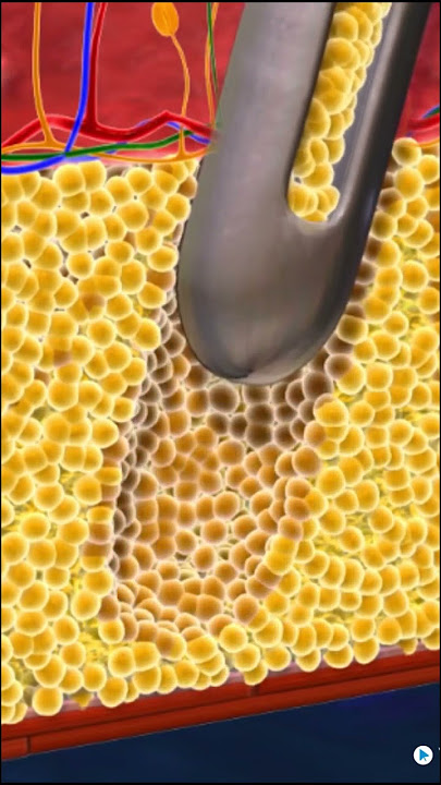 Liposuction: How the procedure works? 🔬