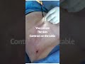 Upper abs skin tightening with @renuvion. Follow us @nuvueu call/text 2039184113