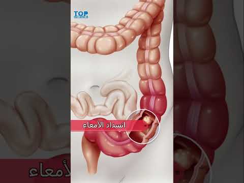 أضرار فاكهة الكاكا