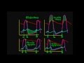 Schneid Guide to Effects of Heart Valve Lesions on the Wiggers Diagram