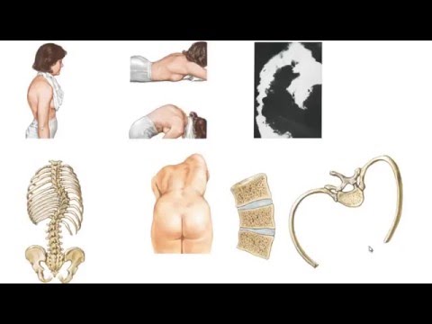Video: Scoliose-accolades Begrijpen: Typen, Gebruik, Effectiviteit En Meer