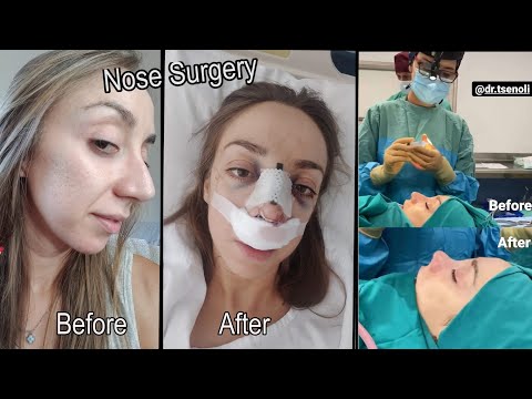 Βίντεο: Ένας μαθητής αποφάσισε να υποβληθεί σε πλαστική χειρουργική για να γίνει ξωτικό