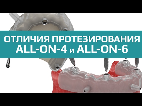 Отличия протезирования all-on-4 от all-on-6