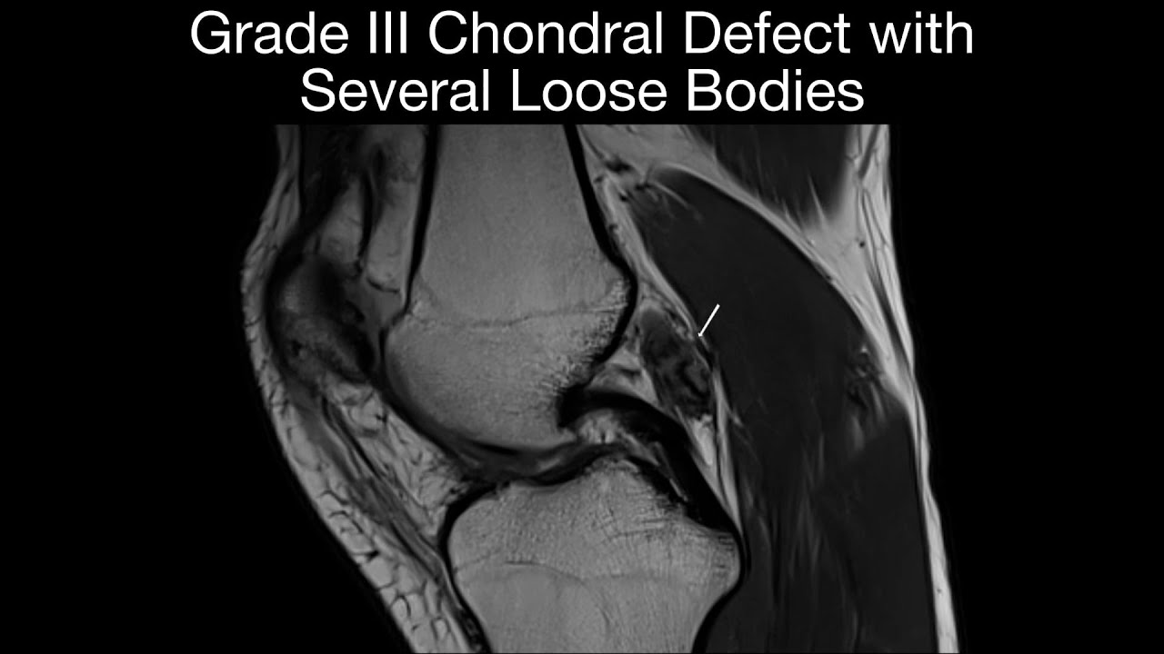 Grade III Chondral Defect with  Several Loose Bodies