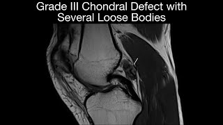 Grade III Chondral Defect with  Several Loose Bodies